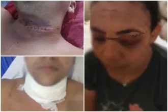 Linha de pipa deixa duas pessoas feridas em Cacoal e reacende alerta sobre uso de cerol